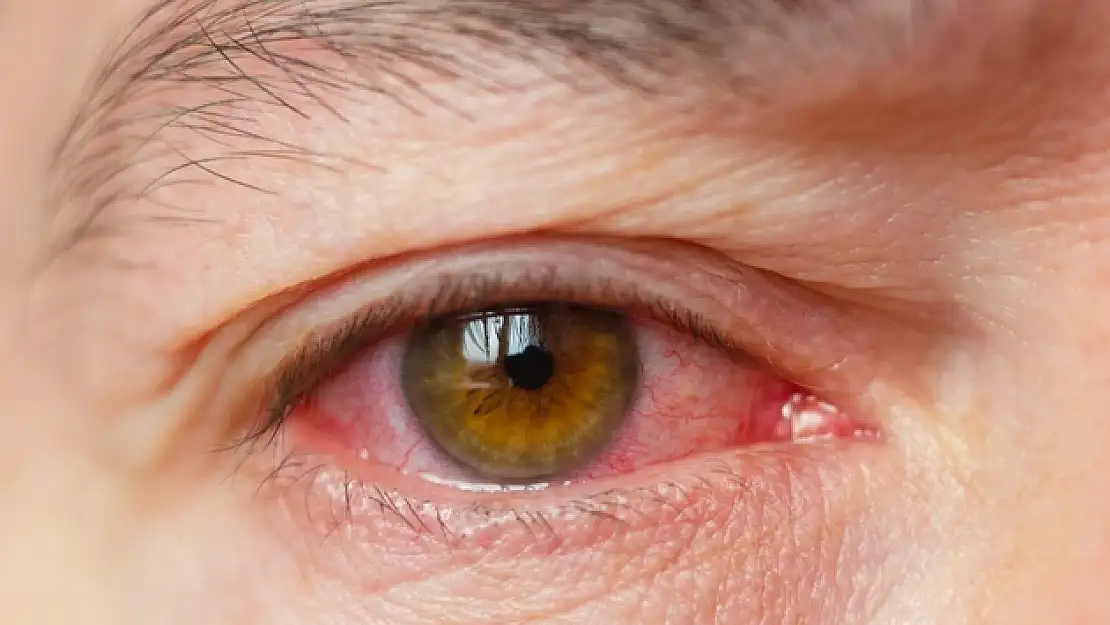 Konjonktivit Salgını nedir? Belirtileri ve tedavisi nelerdir?