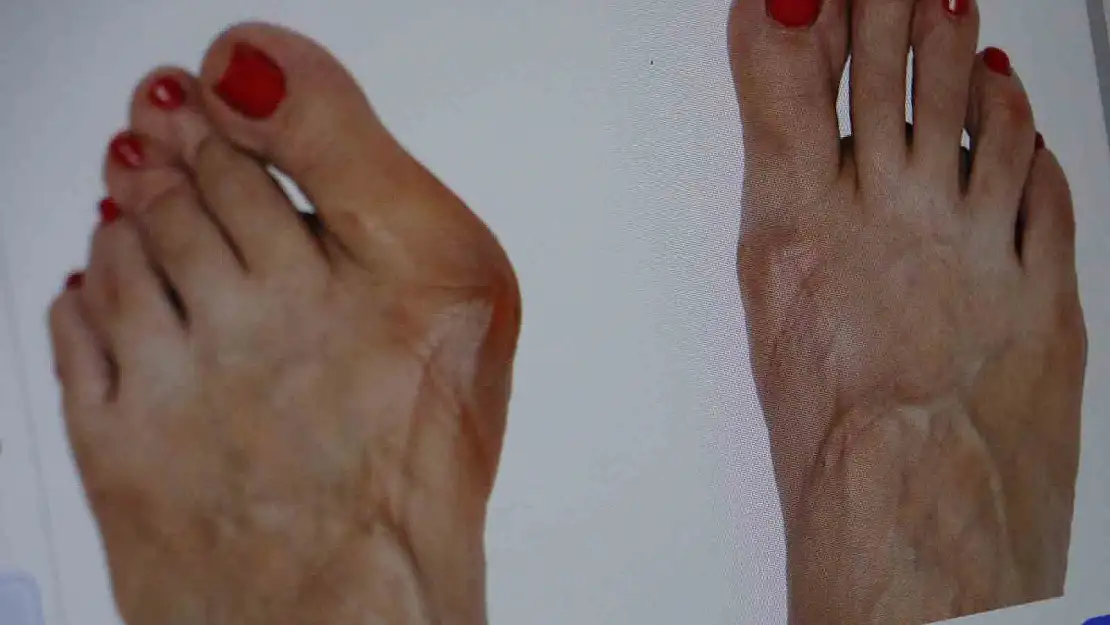 Topuklu ve sivri burun ayakkabı giyenler dikkat