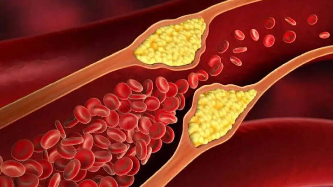 Yüksek kolesterol kardiyovasküler hastalık riskini artırıyor
