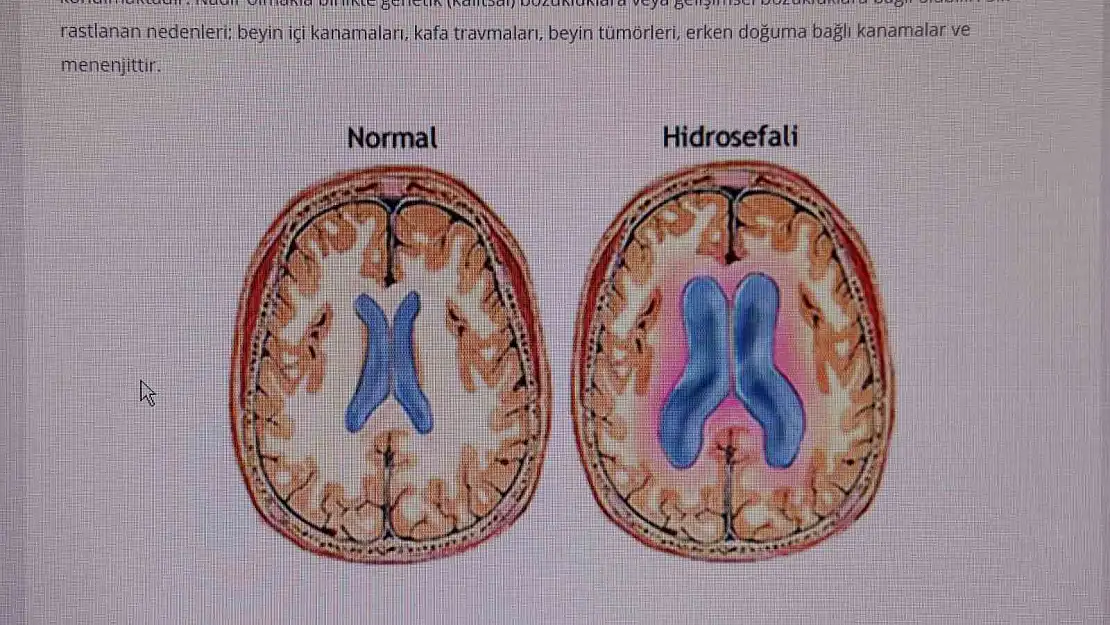 'Hidrosefali' hastalığına dikkat