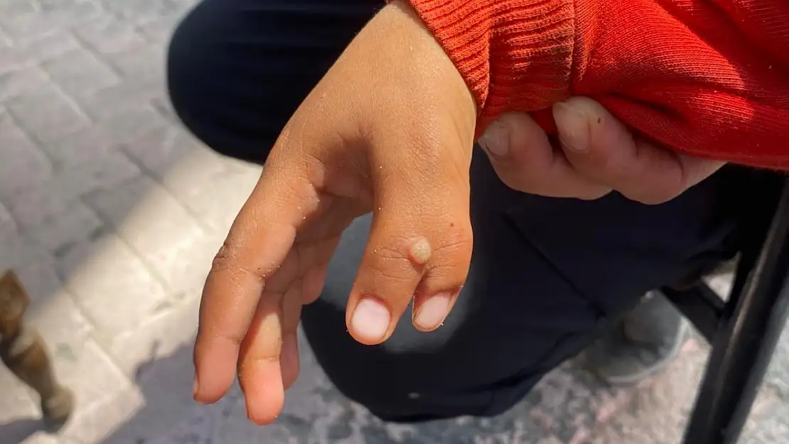 Ağrı'da 6 parmaklı Suriyeli çocuk dikkat çekiyor