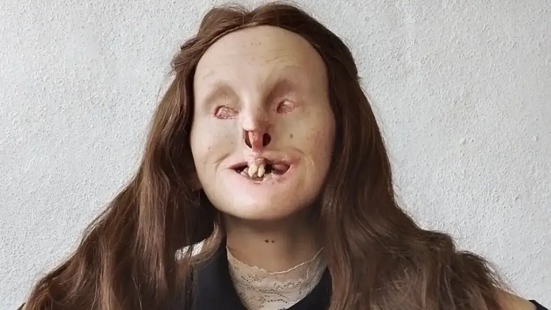 Rabia Yeralmaz Kimdir, Hastalığı Ne, Neden Öyle?