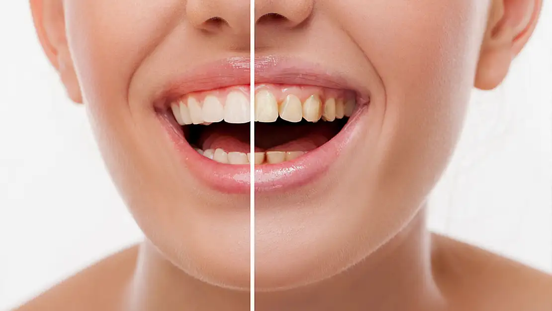 Restoratif Diş Tedavisi Nedir?