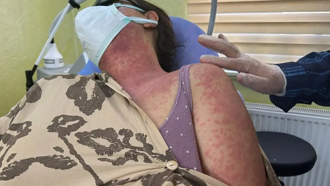 Van'da Beyazlatıcı Krem Kullanımı Sonrası 4 Kişi Hastaneye Kaldırıldı