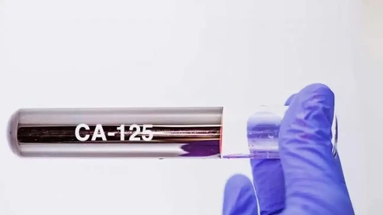 CA-125 kaç olursa kanser olur? CA-125 değeri nasıl düşürülür? CA-125 ca 15 3 ca 19 9 ne demek? Kanserde hangi değerler yüksek çıkar?