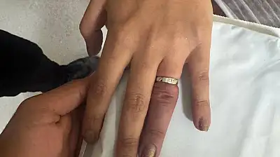 Ağrı'da parmağına sıkışan yüzük için ekipler seferber oldu