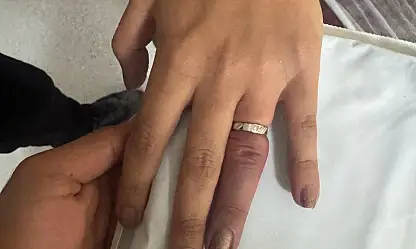 Ağrı'da parmağına sıkışan yüzük için ekipler seferber oldu