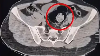 Kars'ta uyuşturucuyu vücutlarında gizlediler: 2 İranlı tutuklandı