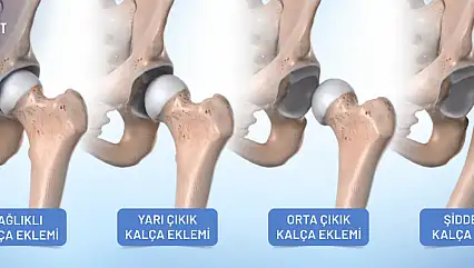Bacak boyu farkı kalça çıkığının ilk işareti olabilir