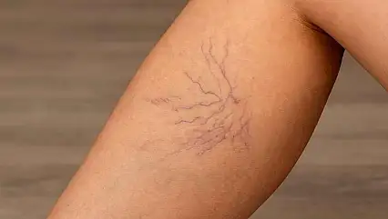 Bacaklarınızdaki mavi damarları hafife almayın!