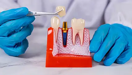 İmplant tedavisinde doğru bakım uzun ömürlü kullanımın anahtarı