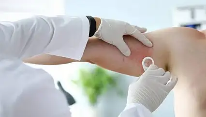 Yaz sıcakları kurdeşen ataklarını artırıyor