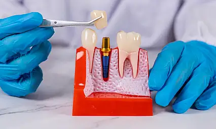 İmplant tedavisinde doğru bakım uzun ömürlü kullanımın anahtarı