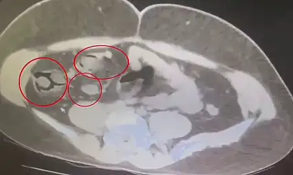 Kars'ta şoke eden olay: İranlı kuryenin midesinden 76 kapsül uyuşturucu çıktı