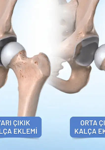 Bacak boyu farkı kalça çıkığının ilk işareti olabilir