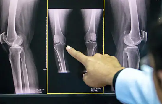Osteoporozdan nasıl korunulur?