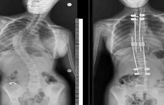 Skolyozlu çocuklar için doğru tedaviyle normal yaşam mümkün