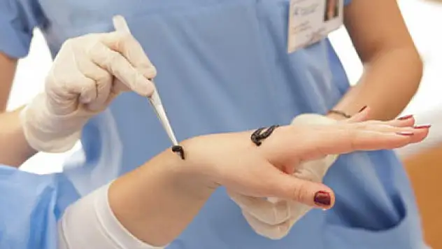 Sülük Nedir? Sülük Tedavisi Nasıl Yapılır? Faydaları Nelerdir? Sizler için araştırdık…