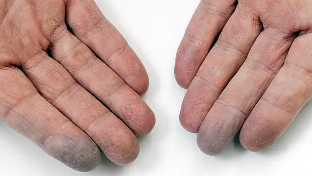 Buerger Hastalığı nedir? Belirtileri ve tedavisi nasıl olur?