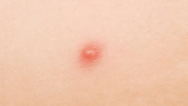Genital bölgede sivilce neden çıkar?