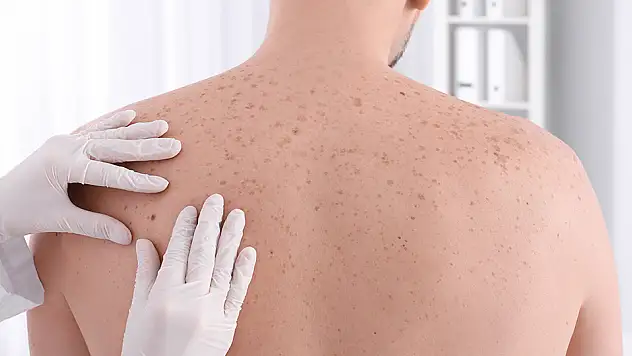 Cilt kanserindeki artışı, güneşte daha uzun kalmak tetikledi
