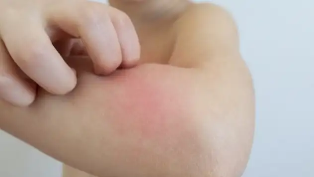Son 10 yılın alerji salgını: Besin alerjileri, giderek artıyor