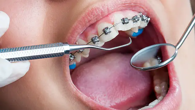 Ortodonti tedavisi için en uygun dönemi uzmanı açıkladı