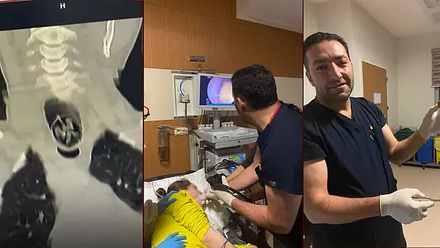 Ağrı'da saniyelerle yarış: Bir kadının yuttuğu ceviz endoskopiyle çıkarıldı