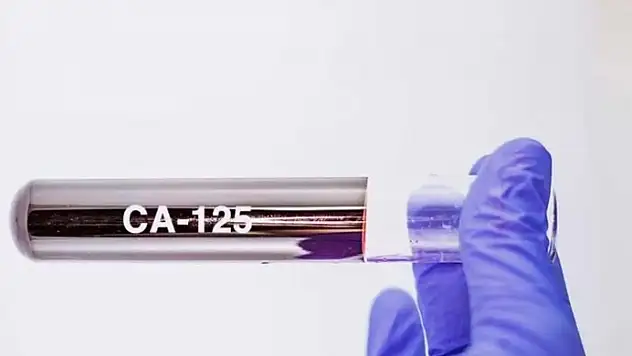 CA-125 kaç olursa kanser olur? CA-125 değeri nasıl düşürülür? CA-125 ca 15 3 ca 19 9 ne demek? Kanserde hangi değerler yüksek çıkar?