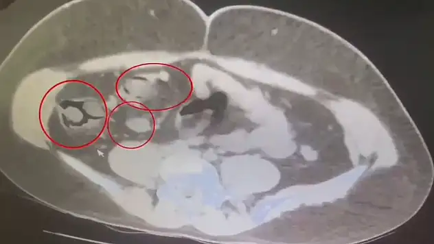 Kars'ta şoke eden olay: İranlı kuryenin midesinden 76 kapsül uyuşturucu çıktı