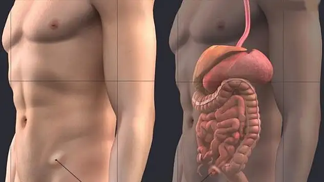 Kasık Fıtığı Nedir? Nasıl Tedavi Edilir?