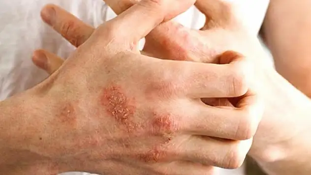 Kaşıntıyla başlayan tehlike: Kış egzaması