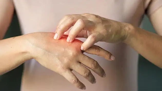 Soğuk hava cildi zorluyor: Kuruluk ve egzama şikâyetleri yükseldi