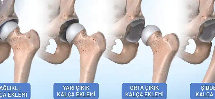 Bacak boyu farkı kalça çıkığının ilk işareti olabilir
