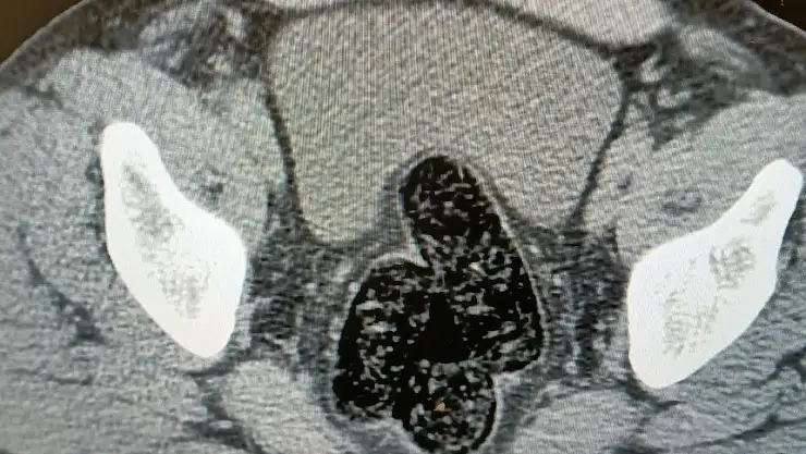Ağrı'da bir şahsın bağırsak ve makat kısmından metamfetamin çıktı