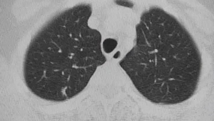 15 yıl sigara içmiş 50 yaş üstü hastalara uyarı