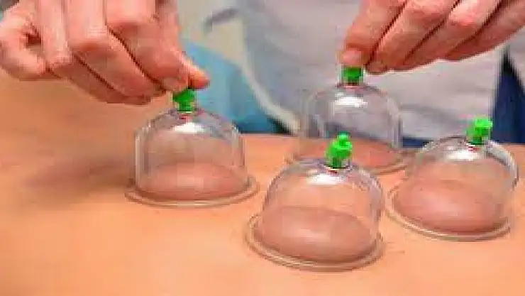 Hacamat nedir? Nasıl yapılır? İşte detaylar