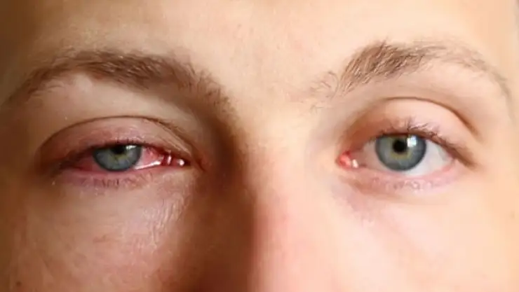 Göz enfeksiyonlarına dikkat! İnanılmaz artış yaşanıyor