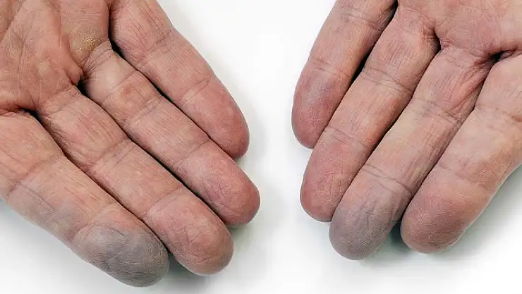 Buerger Hastalığı nedir? Belirtileri ve tedavisi nasıl olur?