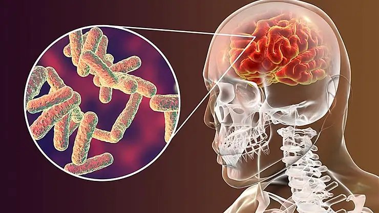 Menenjit tehlikesine dikkat! Menenjit nedir, belirtileri nelerdir?