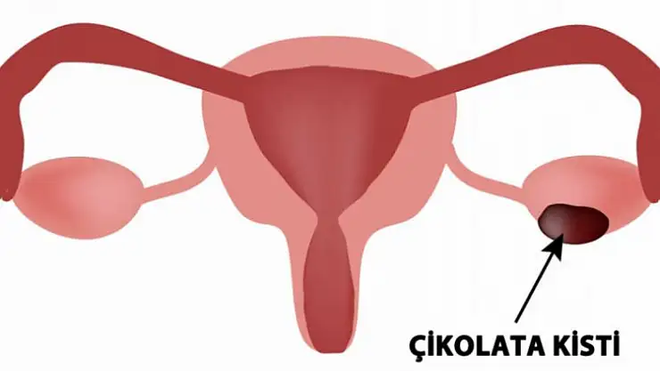 Çikolata kisti (Endometriozis) nedir, belirtileri nelerdir?