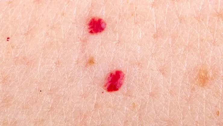 Ciltte bir anda kırmızı ben neden çıkar?