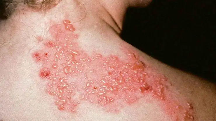 Zona Neden Olur? Zona Hastalığı Tedavisi Var mı?