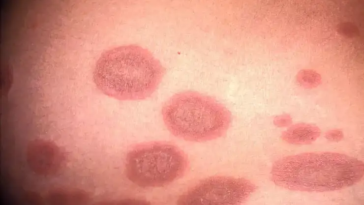 Rüyada vücudunda yaralar görmek, vücudunda yaraların çıkması ne anlama gelir?