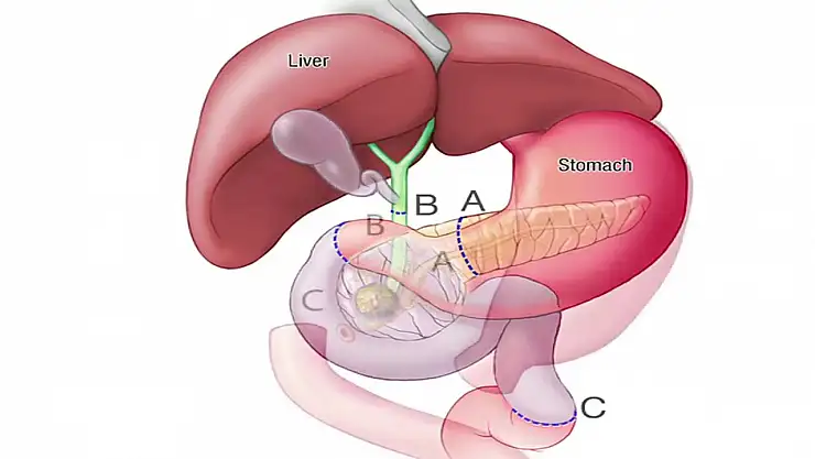 Whipple ameliyatı nedir?