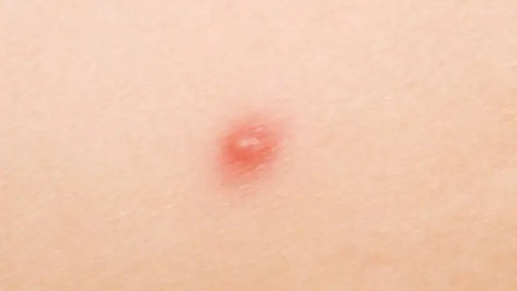 Genital bölgede sivilce neden çıkar?