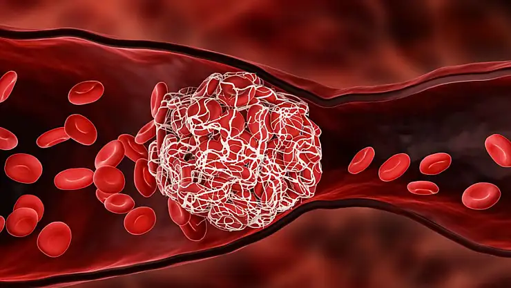 Beyne Pıhtı Neden Atar?