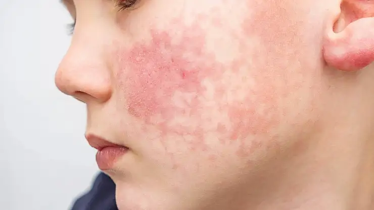 Çocuklarda görülen 'Beşinci Hastalık' nedir, neden olur?