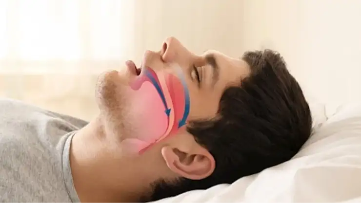 UYKU APNESİNE HANGİ BÖLÜM BAKIYOR? Uyku apnesi nedir, belirtileri neler?