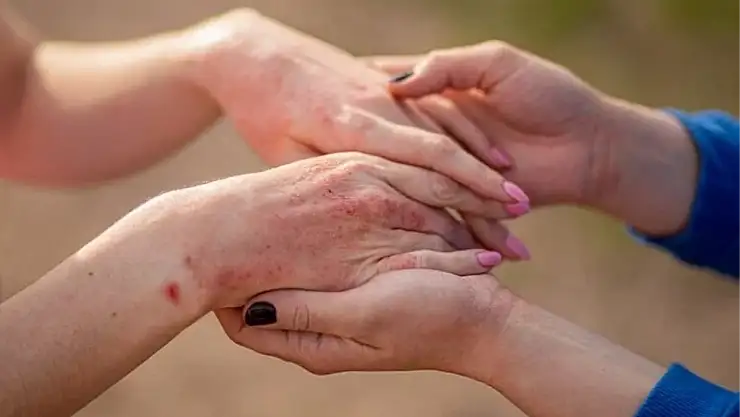 Kelebek Hastalığı belirtisi nedir? Hangi bölüm bakar? Kelebek Hastalığı nedir?